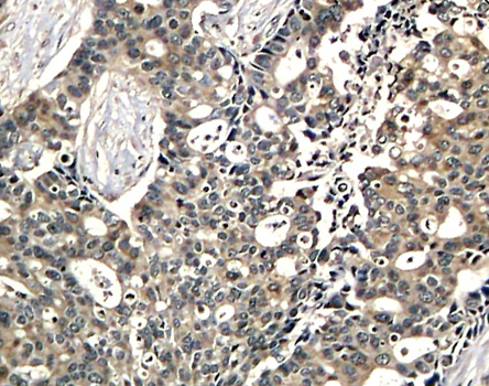 Immunohistochemical analysis of paraffin-embedded human breast carcinoma tissue using Phospho-DOK2-Tyr299 antibody.