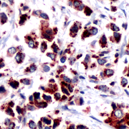 Immunohistochemistry of Human Breast Carcinoma stained with anti-DOK-2 antibody