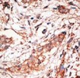 Formalin-fixed and paraffin-embedded human cancer tissue reacted with the primary antibody, which was peroxidase-conjugated to the secondary antibody, followed by DAB staining. This data demonstrates the use of this antibody for immunohistochemistry; clinical relevance has not been evaluated. BC = breast carcinoma; HC = hepatocarcinoma.