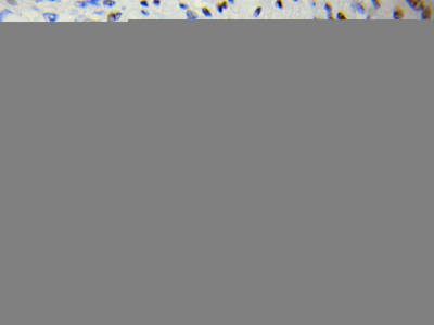 Immunohistochemistry (IHC) analysis of DOK4 pAb in paraffin-embedded Prostate cancer tissue.