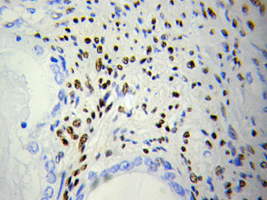 Immunohistochemistry of paraffin-embedded Prostate cancer using DOK4 Antibody.