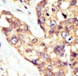 Formalin-fixed and paraffin-embedded human cancer tissue reacted with the primary antibody, which was peroxidase-conjugated to the secondary antibody, followed by AEC staining. This data demonstrates the use of this antibody for immunohistochemistry; clinical relevance has not been evaluated. BC = breast carcinoma; HC = hepatocarcinoma.