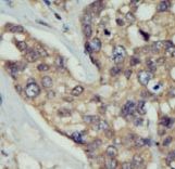 Formalin-fixed and paraffin-embedded human cancer tissue reacted with the primary antibody, which was peroxidase-conjugated to the secondary antibody, followed by DAB staining. This data demonstrates the use of this antibody for immunohistochemistry; clinical relevance has not been evaluated. BC = breast carcinoma; HC = hepatocarcinoma.