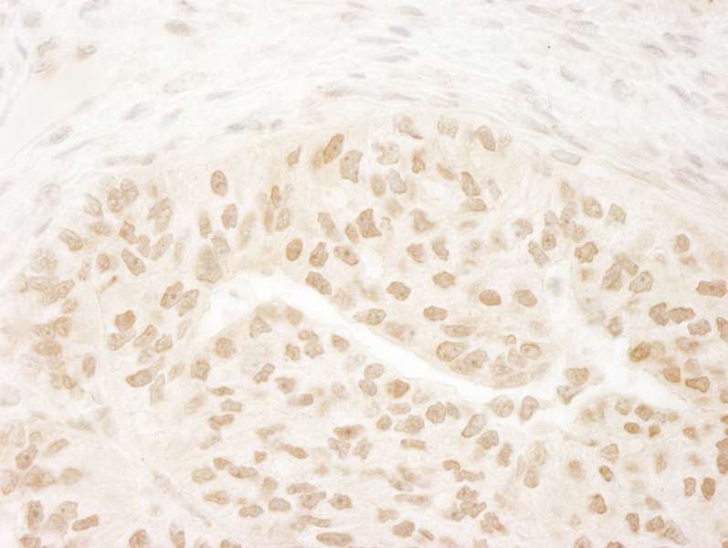Detection of Human DOT1L by Immunohistochemistry. Sample: FFPE section of human lung carcinoma. Antibody: Affinity purified rabbit anti-DOT1L used at a dilution of 1:200 (1 Detection: DAB.