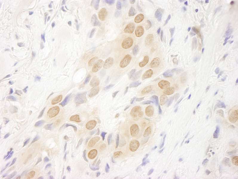 Detection of Human DOT1L by Immunohistochemistry. Sample: FFPE section of human breast carcinoma. Antibody: Affinity purified rabbit anti-DOT1L used at a dilution of 1:100. Epitope Retrieval Buffer-High pH (IHC-101J) was substituted for Epitope Retrieval Buffer-Reduced pH.