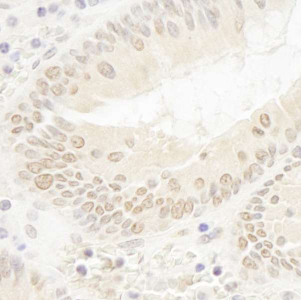 Detection of Human DOT1L by Immunohistochemistry. Sample: FFPE section of human colon carcinoma. Antibody: Affinity purified rabbit anti-DOT1L used at a dilution of 1:100. Epitope Retrieval Buffer-High pH (IHC-101J) was substituted for Epitope Retrieval Buffer-Reduced pH.