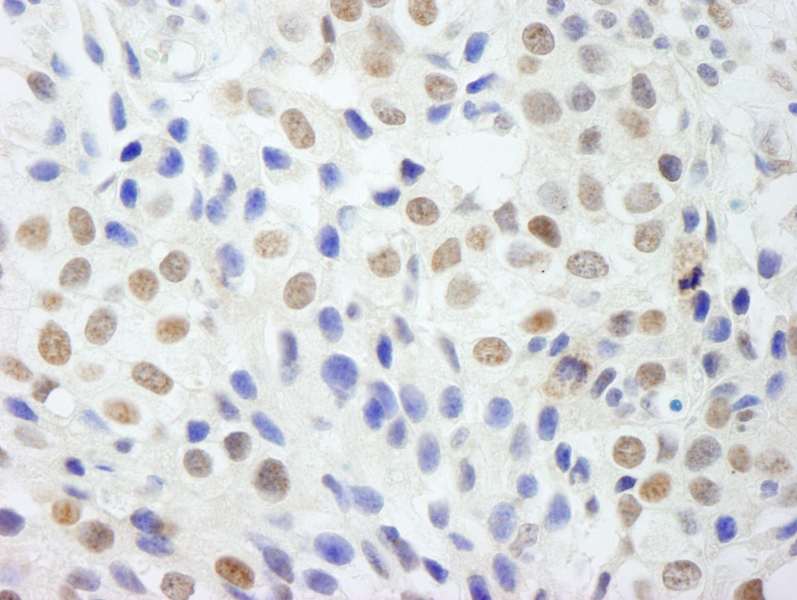 Detection of Human DDX54 by Immunohistochemistry. Sample: FFPE section of human breast carcinoma. Antibody: Affinity purified rabbit anti-DDX54 used at a dilution of 1:250.