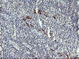 IHC of paraffin-embedded Human lymphoma tissue using anti-DPCD mouse monoclonal antibody. (Heat-induced epitope retrieval by 10mM citric buffer, pH6.0, 120°C for 3min).