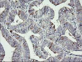 IHC of paraffin-embedded Adenocarcinoma of Human endometrium tissue using anti-DPCD mouse monoclonal antibody. (Heat-induced epitope retrieval by 10mM citric buffer, pH6.0, 120°C for 3min).
