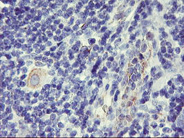 IHC of paraffin-embedded Human lymphoma tissue using anti-DPP9 mouse monoclonal antibody.