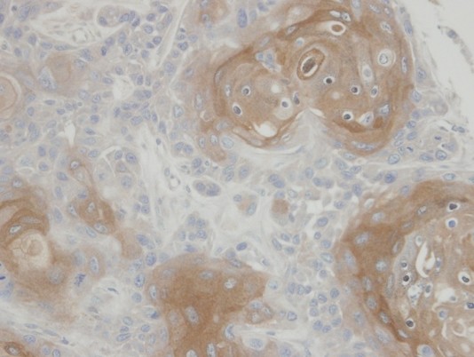 IHC of paraffin-embedded Ca922 xenograft using CLIC3 antibody at 1:100 dilution.