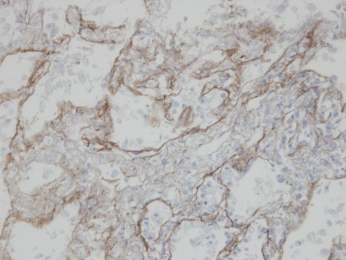 IHC of paraffin-embedded T (IV) (lung CA) using CLIC3 antibody at 1:100 dilution.