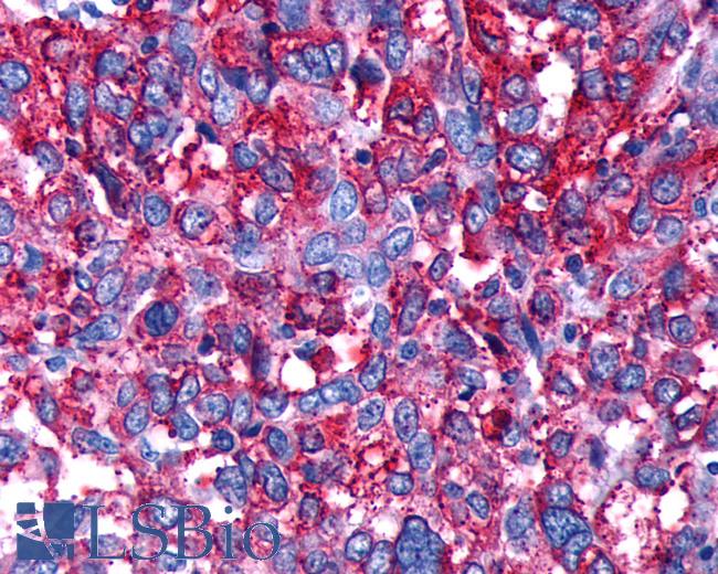 Anti-DRD4 / Dopamine Receptor D4 antibody IHC of human Ovary, Carcinoma. Immunohistochemistry of formalin-fixed, paraffin-embedded tissue after heat-induced antigen retrieval.