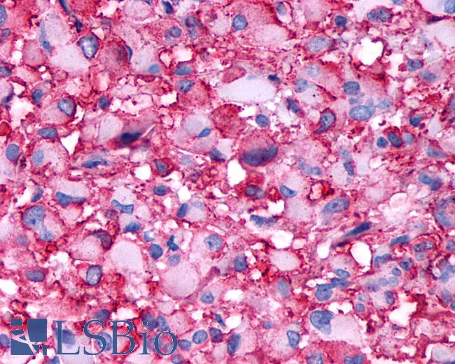 Anti-DRD4 / Dopamine Receptor D4 antibody IHC of human Brain, Glioblastoma. Immunohistochemistry of formalin-fixed, paraffin-embedded tissue after heat-induced antigen retrieval.