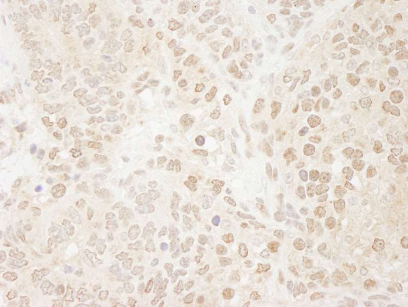 Detection of Mouse Drosha by Immunohistochemistry. Sample: FFPE section of mouse teratoma. Antibody: Affinity purified rabbit anti-Drosha used at a dilution of 1:250. Epitope Retrieval Buffer-High pH (IHC-101J) was substituted for Epitope Retrieval Buffer-Reduced pH.
