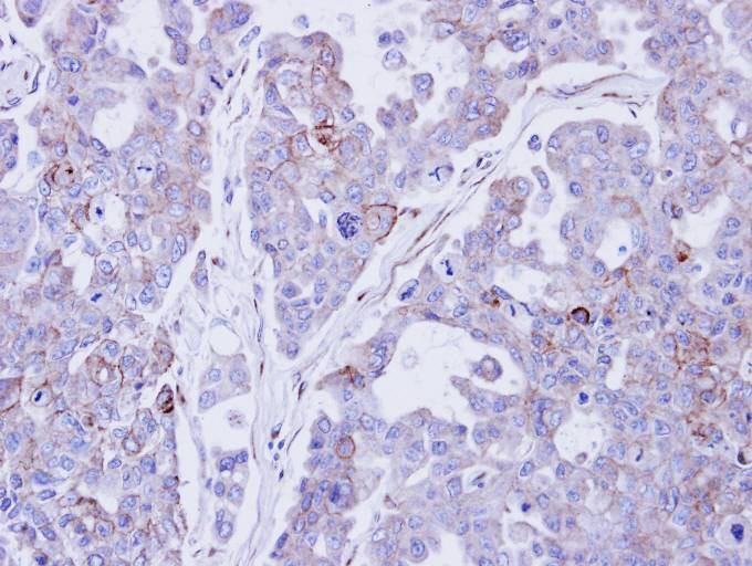 IHC of paraffin-embedded OVCAR3 xenograft using Desmocollin 2 antibody at 1:500 dilution.