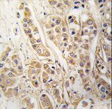 Formalin-fixed and paraffin-embedded human breast carcinoma tissue reacted with CLIC4 antibody , which was peroxidase-conjugated to the secondary antibody, followed by DAB staining. This data demonstrates the use of this antibody for immunohistochemistry; clinical relevance has not been evaluated.