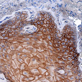 Desmoglein-3 in Human Squamous Cell Carcinoma. Desmoglein-3 was detected in immersion fixed paraffin-embedded sections of human squamous cell carcinoma using Mouse Anti-Human Desmoglein-3 Monoclonal Antibody at 8 ug/ml overnight at 4°C. Tissue was stained using Anti-Mouse HRP-DAB (brown) and counterstained with hematoxylin (blue). Specific staining was localized to plasma membranes of keratinocytes.