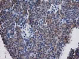 IHC of paraffin-embedded Carcinoma of Human thyroid tissue using anti-DSTN mouse monoclonal antibody. (Heat-induced epitope retrieval by 10mM citric buffer, pH6.0, 100C for 10min).