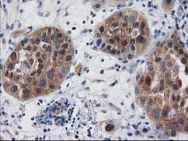 IHC of paraffin-embedded Carcinoma of Human bladder tissue using anti-DSTN mouse monoclonal antibody. (Heat-induced epitope retrieval by 10mM citric buffer, pH6.0, 100C for 10min).