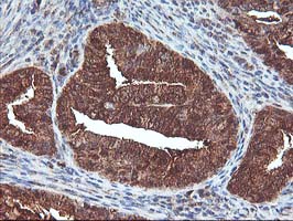 IHC of paraffin-embedded Adenocarcinoma of Human endometrium tissue using anti-DSTN mouse monoclonal antibody.