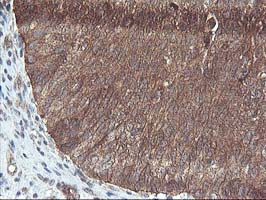 IHC of paraffin-embedded Carcinoma of Human bladder tissue using anti-DSTN mouse monoclonal antibody.