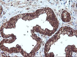 IHC of paraffin-embedded Carcinoma of Human prostate tissue using anti-DSTN mouse monoclonal antibody.