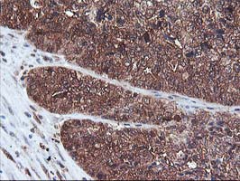 IHC of paraffin-embedded Adenocarcinoma of Human ovary tissue using anti-DSTN mouse monoclonal antibody.