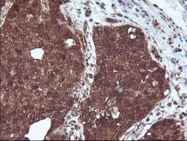 IHC of paraffin-embedded Carcinoma of Human lung tissue using anti-DSTN mouse monoclonal antibody.