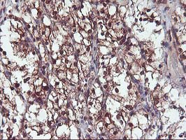IHC of paraffin-embedded Carcinoma of Human kidney tissue using anti-DSTN mouse monoclonal antibody.