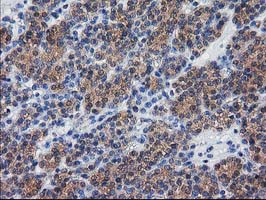 IHC of paraffin-embedded Carcinoma of Human thyroid tissue using anti-DSTN mouse monoclonal antibody. (Heat-induced epitope retrieval by 10mM citric buffer, pH6.0, 100C for 10min).