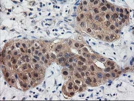 IHC of paraffin-embedded Carcinoma of Human bladder tissue using anti-DSTN mouse monoclonal antibody. (Heat-induced epitope retrieval by 10mM citric buffer, pH6.0, 100C for 10min).