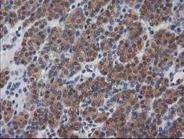 IHC of paraffin-embedded Carcinoma of Human thyroid tissue using anti-DSTN mouse monoclonal antibody. (Heat-induced epitope retrieval by 10mM citric buffer, pH6.0, 100C for 10min).
