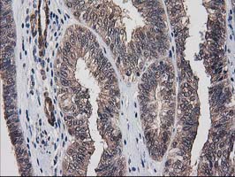 IHC of paraffin-embedded Adenocarcinoma of Human endometrium tissue using anti-DSTN mouse monoclonal antibody. (Heat-induced epitope retrieval by 10mM citric buffer, pH6.0, 100C for 10min).