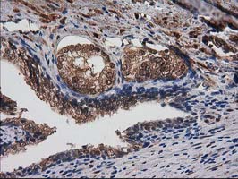 IHC of paraffin-embedded Carcinoma of Human prostate tissue using anti-DSTN mouse monoclonal antibody. (Heat-induced epitope retrieval by 10mM citric buffer, pH6.0, 100C for 10min).