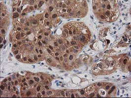 IHC of paraffin-embedded Carcinoma of Human bladder tissue using anti-DSTN mouse monoclonal antibody. (Heat-induced epitope retrieval by 10mM citric buffer, pH6.0, 100C for 10min).