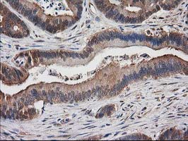 IHC of paraffin-embedded Adenocarcinoma of Human colon tissue using anti-DSTN mouse monoclonal antibody. (Heat-induced epitope retrieval by 10mM citric buffer, pH6.0, 100C for 10min).