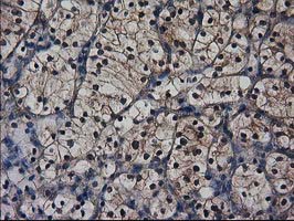 IHC of paraffin-embedded Carcinoma of Human kidney tissue using anti-DSTN mouse monoclonal antibody. (Heat-induced epitope retrieval by 10mM citric buffer, pH6.0, 100C for 10min).