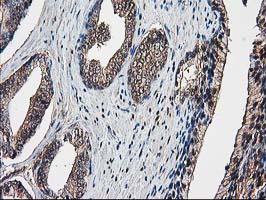 IHC of paraffin-embedded Carcinoma of Human prostate tissue using anti-DSTN mouse monoclonal antibody. (Heat-induced epitope retrieval by 10mM citric buffer, pH6.0, 100C for 10min).