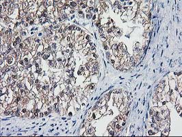IHC of paraffin-embedded Adenocarcinoma of Human ovary tissue using anti-DSTN mouse monoclonal antibody. (Heat-induced epitope retrieval by 10mM citric buffer, pH6.0, 100C for 10min).