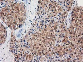 IHC of paraffin-embedded Adenocarcinoma of Human breast tissue using anti-DSTN mouse monoclonal antibody. (Heat-induced epitope retrieval by 10mM citric buffer, pH6.0, 100C for 10min).
