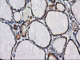 IHC of paraffin-embedded Human thyroid tissue using anti-DSTN mouse monoclonal antibody.