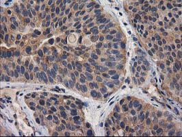 IHC of paraffin-embedded Carcinoma of Human bladder tissue using anti-DSTN mouse monoclonal antibody.