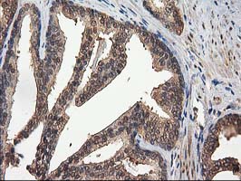 IHC of paraffin-embedded Carcinoma of Human prostate tissue using anti-DSTN mouse monoclonal antibody.