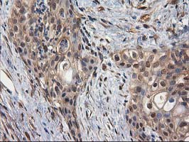 IHC of paraffin-embedded Carcinoma of Human pancreas tissue using anti-DSTN mouse monoclonal antibody.