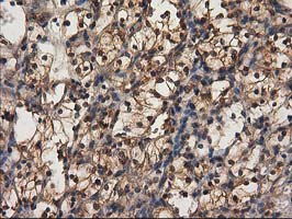IHC of paraffin-embedded Carcinoma of Human kidney tissue using anti-DSTN mouse monoclonal antibody.
