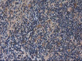 IHC of paraffin-embedded Human lymphoma tissue using anti-DSTN mouse monoclonal antibody.