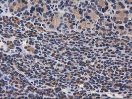 IHC of paraffin-embedded Carcinoma of Human thyroid tissue using anti-DSTN mouse monoclonal antibody.