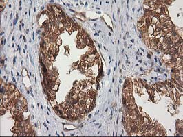 IHC of paraffin-embedded Adenocarcinoma of Human ovary tissue using anti-DSTN mouse monoclonal antibody.
