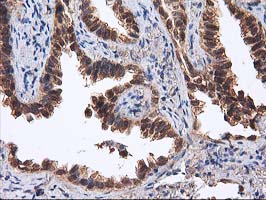 IHC of paraffin-embedded Carcinoma of Human lung tissue using anti-DSTN mouse monoclonal antibody.